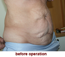 plastic-surgery-tummy-tuck